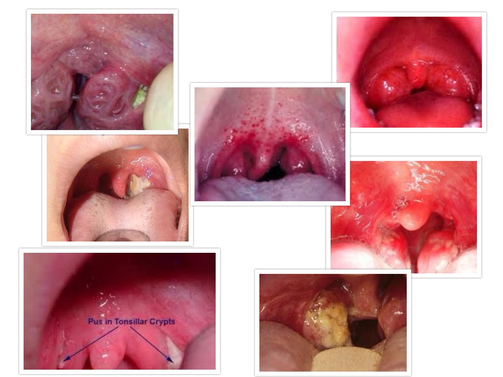 Strep Throat Tonsils 31