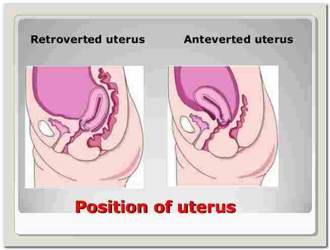 Anteverted Uterus Symptoms Pictures Treatment And Pregnancy