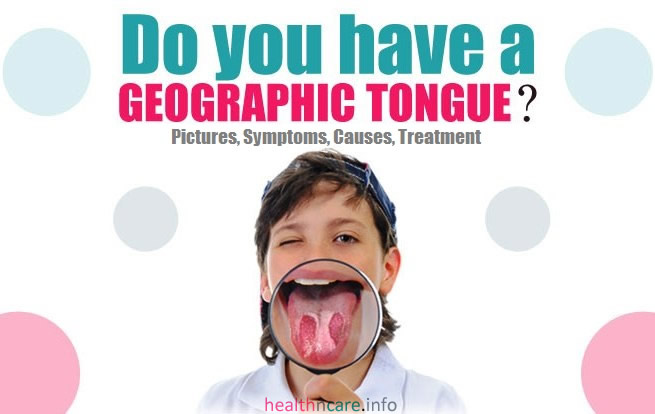 Geographic Tongue Pictures, Symptoms, Treatment, Causes
