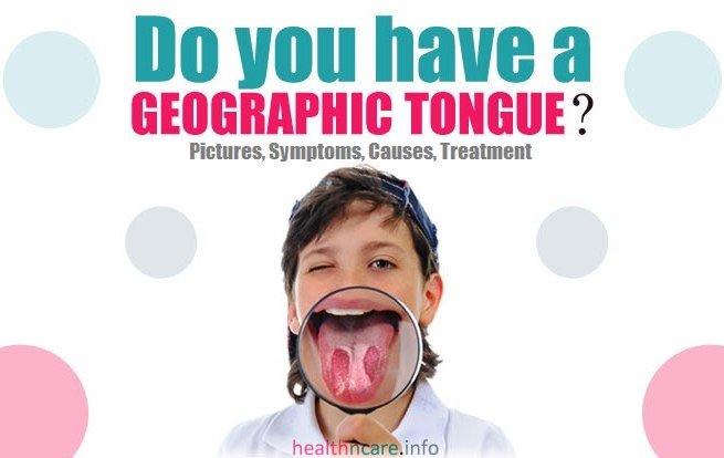 Geographic Tongue - Pictures, Treatment, Symptoms, Causes