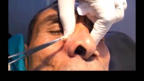 Pictures of Cyst on nose