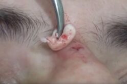 Treatment of cyst on nose