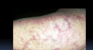 Livedo Reticularis (Mottling Skin) Causes, Pictures, Treatment