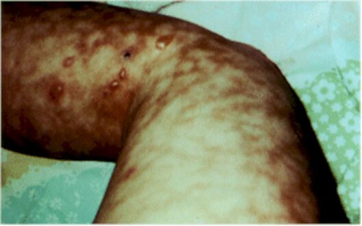 Livedo Reticularis Pictures