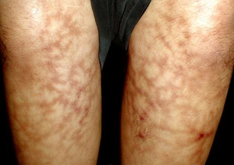 Livedo Reticularis Mottling Skin Causes Pictures Treatment 8309