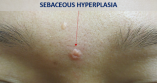 Sebaceous Glands Hyperplasia Photos and Treatment