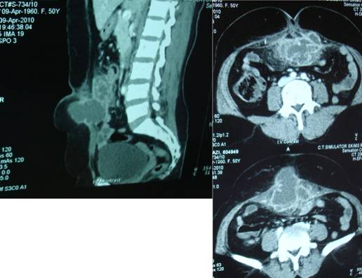 Spigelian Hernia Symptoms Ct Pictures Causes Repair Procedure