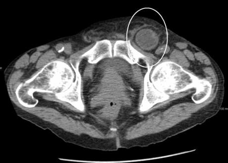 Hernia CT Scan Images