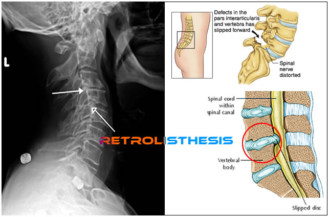 L4-l5 degenerative retrolisthesis