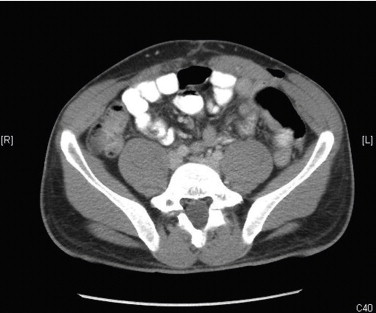 Spigelian Hernia Symptoms, CT, Pictures, Causes, Repair Procedure