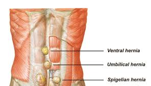 Spigelian Hernia Pictures
