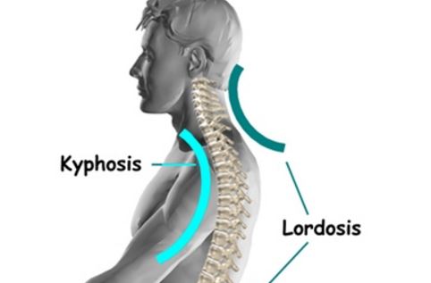 Cervical Lordosis - Loss, Reversal, Treatment