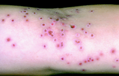 Eczema Herpeticum - Symptoms and Treatment