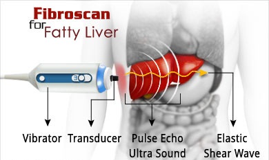 Fibroscan Test for Liver Fibrosis - Cost, Score, Result