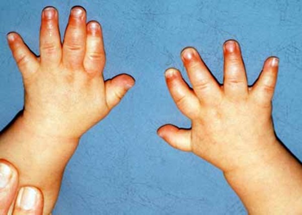 Experts React: What These **Prader Willi Syndrome Pictures** Reveal About Pws. - kg7mnr0