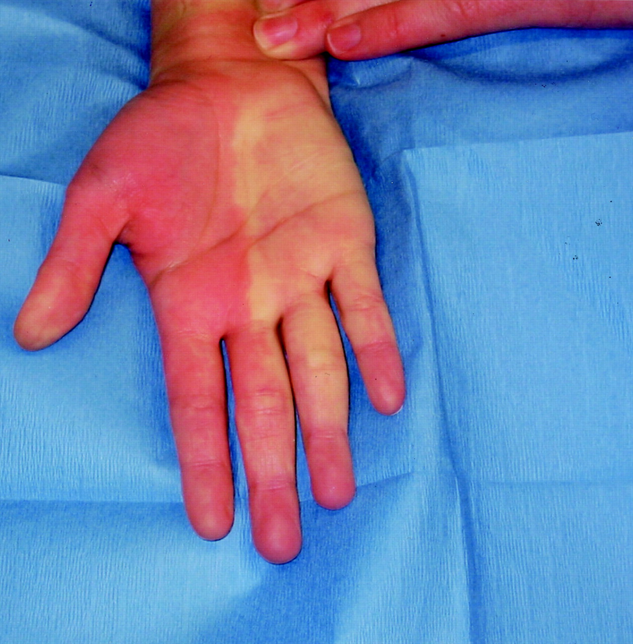 Allen Test Procedure Results Types Positive Allen Test Allen Test Procedure Results Types Positive Allen Test