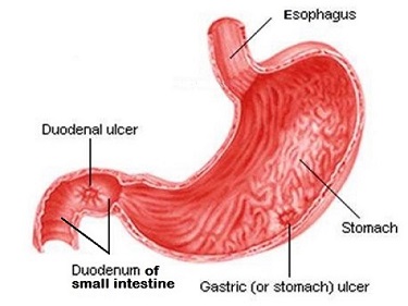 Gastrinoma Symptoms, Causes, Prognosis, Treatment