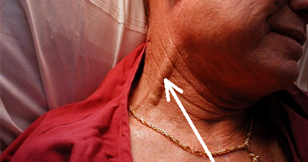 kussmaul sign Mechanism, Pathophysiology, Causes, Treatment