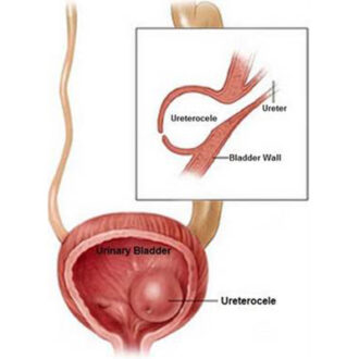  Ureterocele Pictures, Symptoms, Causes, Diagnosis, Treatment, Ultrasound