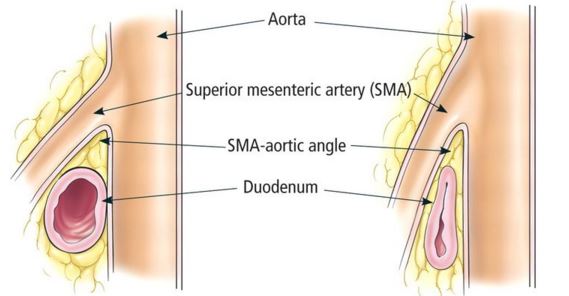 SMAS- Superior Mesenteric Artery Syndrome Symptoms, Treatment