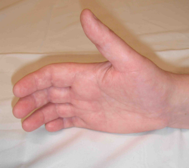 Sudeck's Atrophy Symptoms, Causes, Treatment