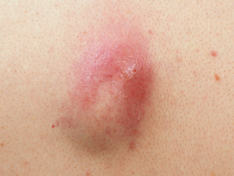 Vulvar Abscess Pictures Symptoms Causes Treatment