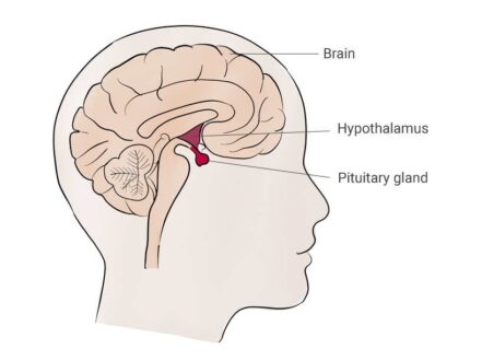 Panhypopituitarism Prognosis, Symptoms, Causes, Treatment