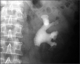 uti and staghorn calculus