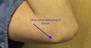 Subluxing ulnar nerve Test, Taping, Symptoms, Treatment