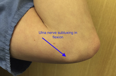 Subluxing Ulnar Nerve