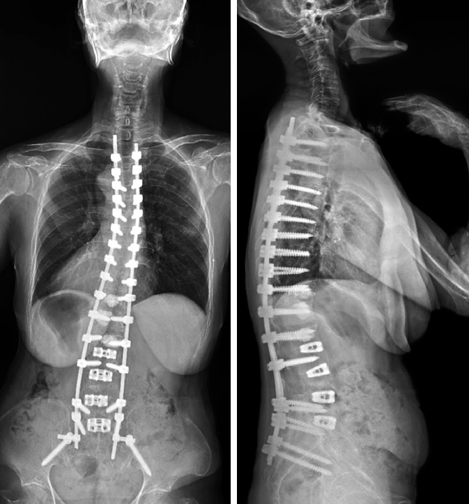 Proximal junctional kyphosis Symptoms, Causes, Treatment