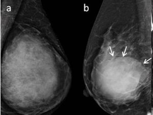 Phyllodes tumor vs Fibroadenoma Symptoms, Causes, Diagnosis, Treatment