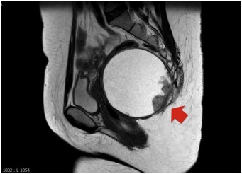 Tailgut Cyst Location, Symptoms, Cancer, Removal