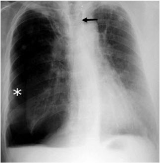 Mounier kuhn syndrome Symptoms, Causes, Treatmen