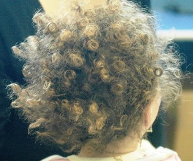 Woolly Hair Syndrome Symptoms, Causes, Diagnosis, Treatment