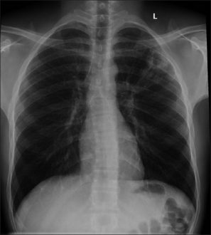 Pulmonary Cryptococcosis Symptoms, Causes, Diagnosis, Treatment