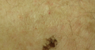 Ink Spot Lentigo Symptoms, Causes, Dermoscopy, Removal