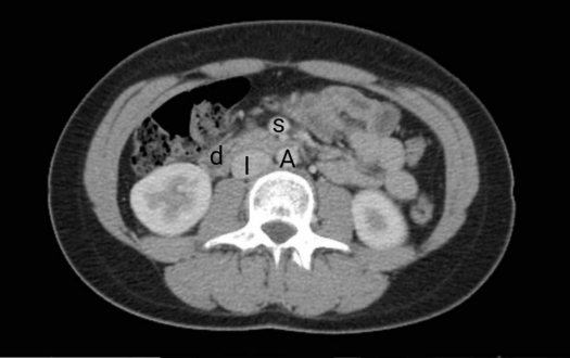 Wilkie's Syndrome Symptoms, Causes, Surgery, Life expectancy