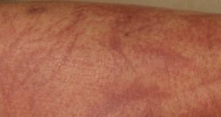 Shiitake Dermatitis Symptoms, Causes, Diagnosis, Treatment