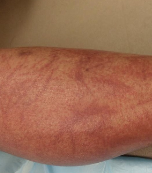 Shiitake Dermatitis Symptoms, Causes, Diagnosis, Treatment