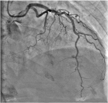 Kounis Syndrome Symptoms, ECG, Diagnosis, Causes, Treatment