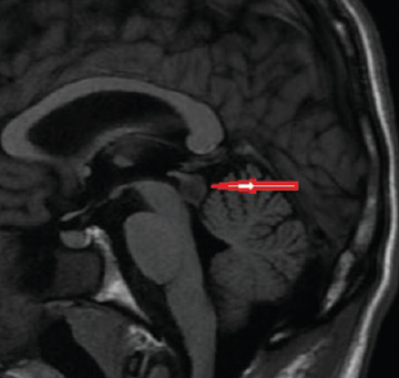 Tectal Glioma Symptoms, Causes, Prognosis, Treatment