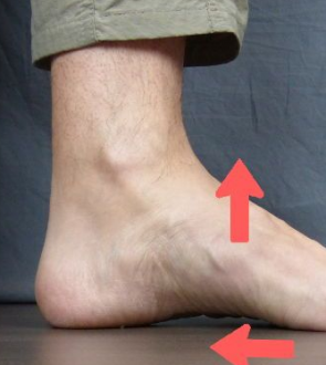 Hindfoot Valgus Symptoms, Causes, Exercises, Surgery