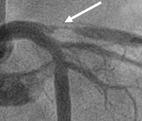 Lad Stenosis