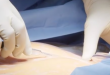 Limberg Flap Surgery Procedure, Technique, Complications, Care