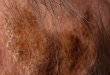 Erosive Pustular Dermatosis of the Scalp Symptoms, Causes, Treatment