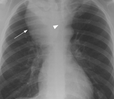 Left & Right Paratracheal Mass Symptoms, Causes, Treatment