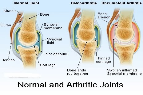 Arthritic Joints vs Normal Joints