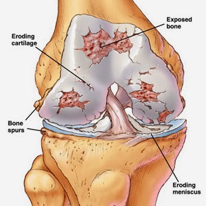 Arthritis Anatomy