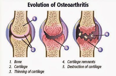 Arthritis Osteoarthritis Stages